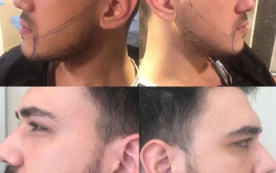 trapianto barba